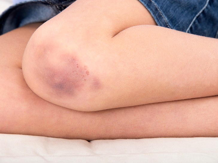 Immune-Thrombocytopenia