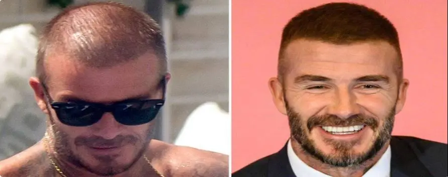 کاشت موی دیوید بکام 