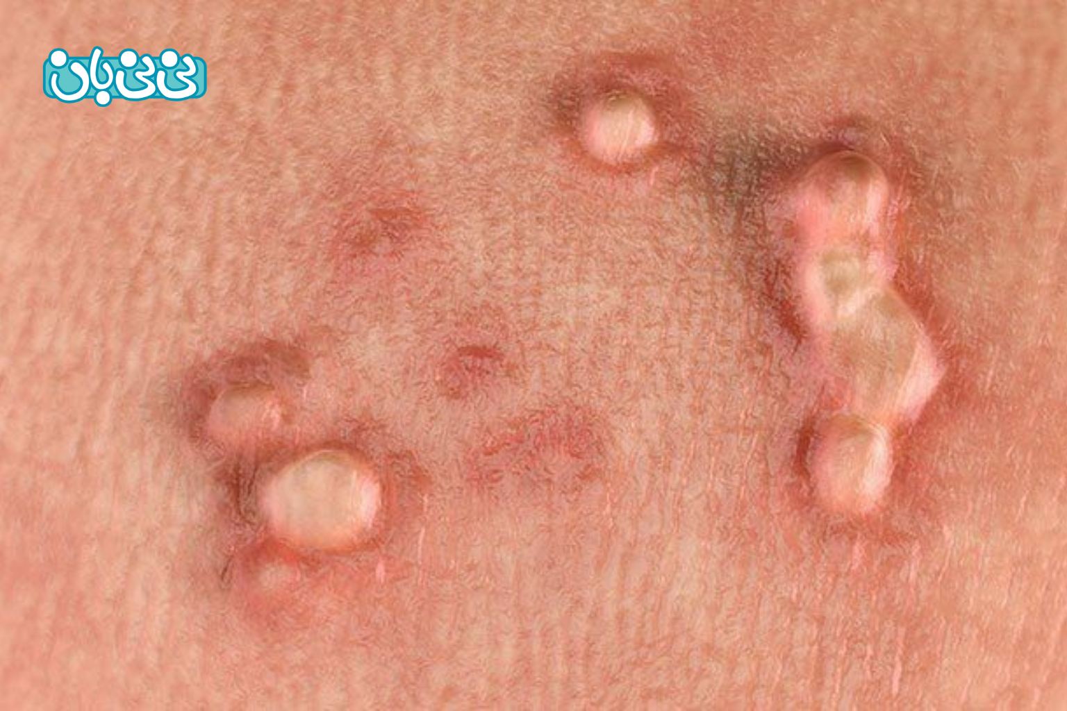 علائم زگیل تناسلی در زنان عکس