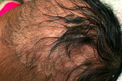 C0525446-Cradle_cap_copy.original.2e16d0ba.fill-420x280