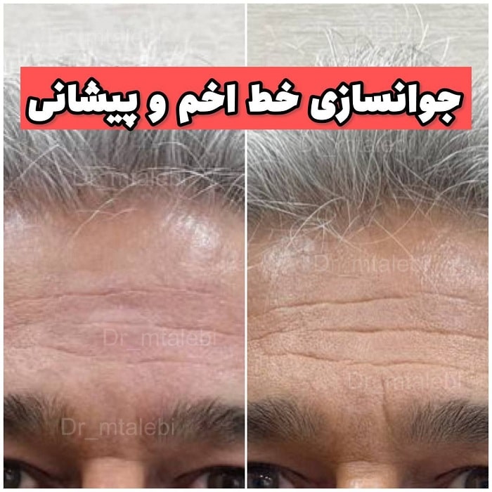 فرایند انجام تزریق کلاژن