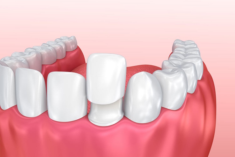 سن مناسب لمینت دندان چه سنی است؟