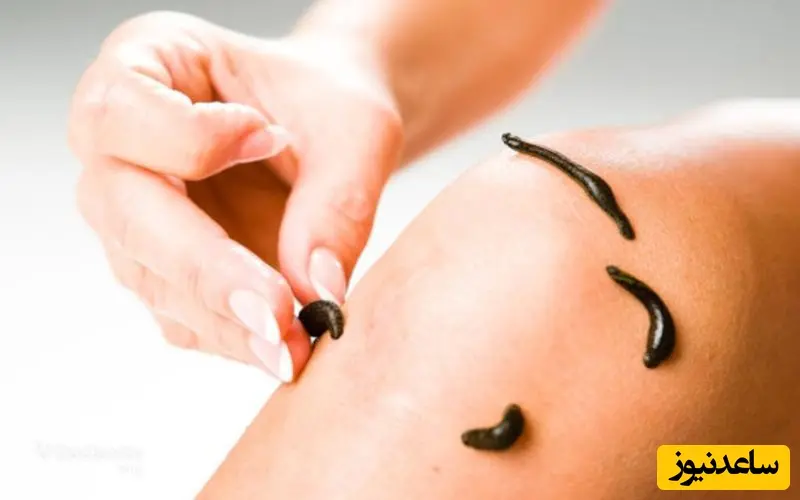 حجامت و زالودرمانی