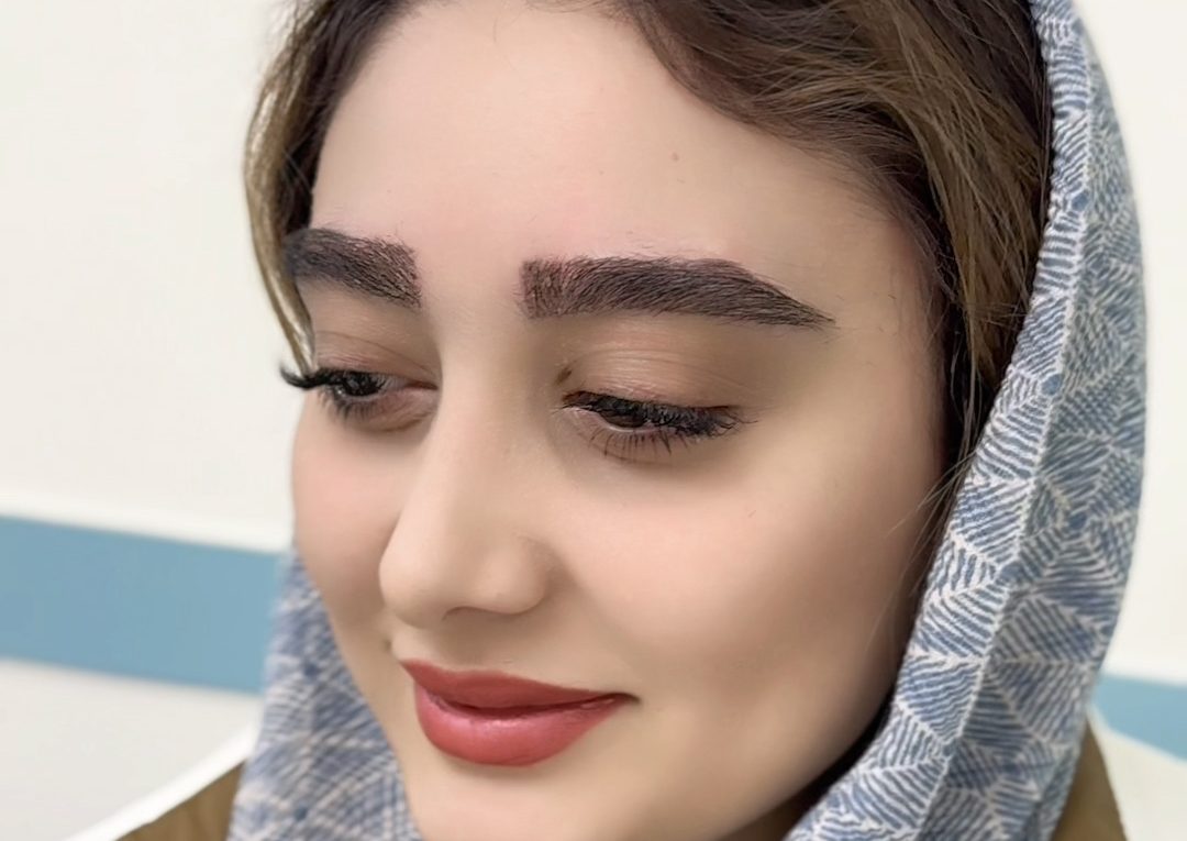 -کاشت-ابرو-e1740565724788