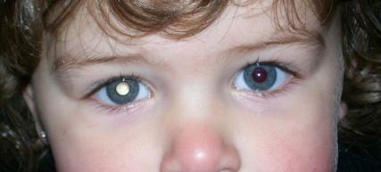 retinoblastoma (1)