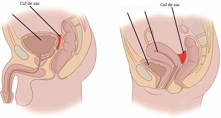 مایع آزاد در کلدوساک خلفی، یعنی چه؟