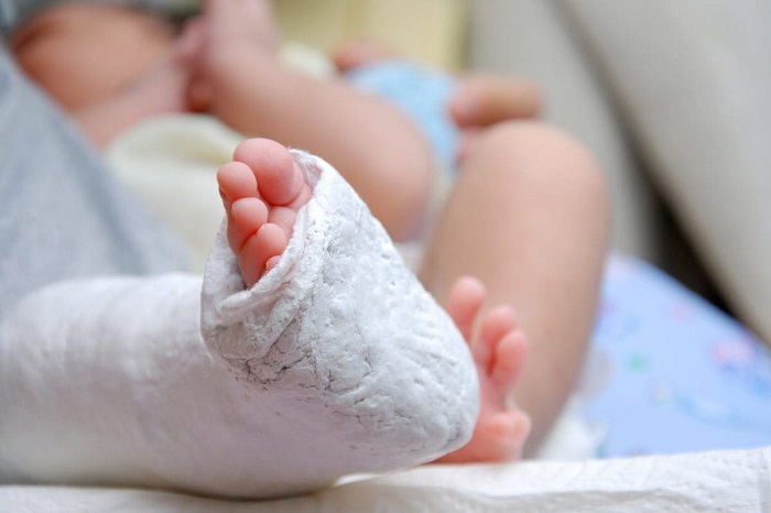 تشخیص پای پرانتزی در کودکان، علت و درمان