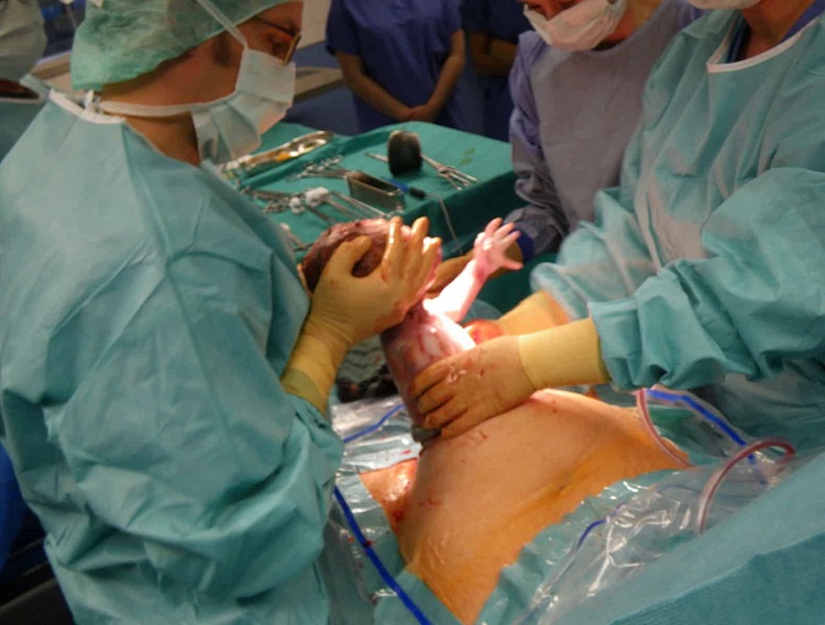 Caesarian_section111