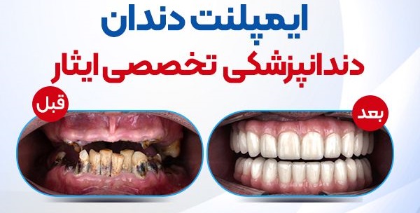 ايمپلنت و ارتودنسي و كامپوزيت دندان