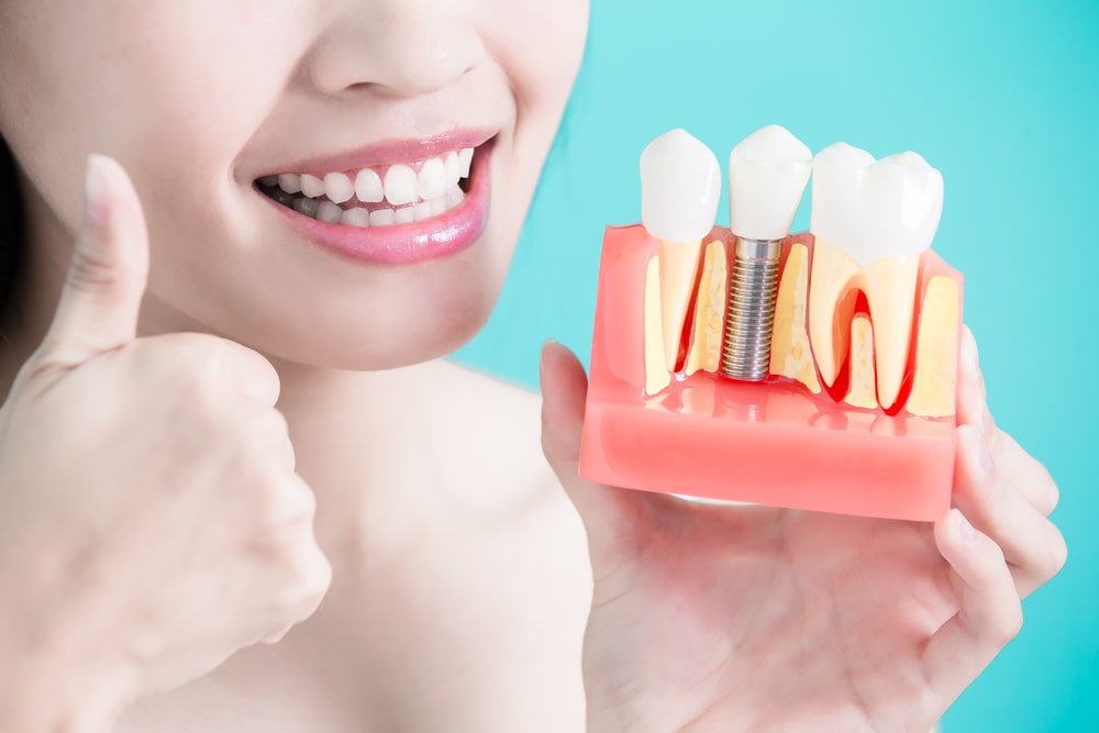 Dental-Implant-Services-in-Calgary