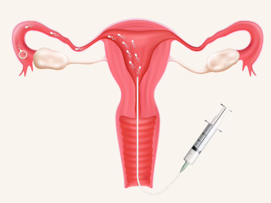 تلقیح داخل رحمی (IUI) چیست؟