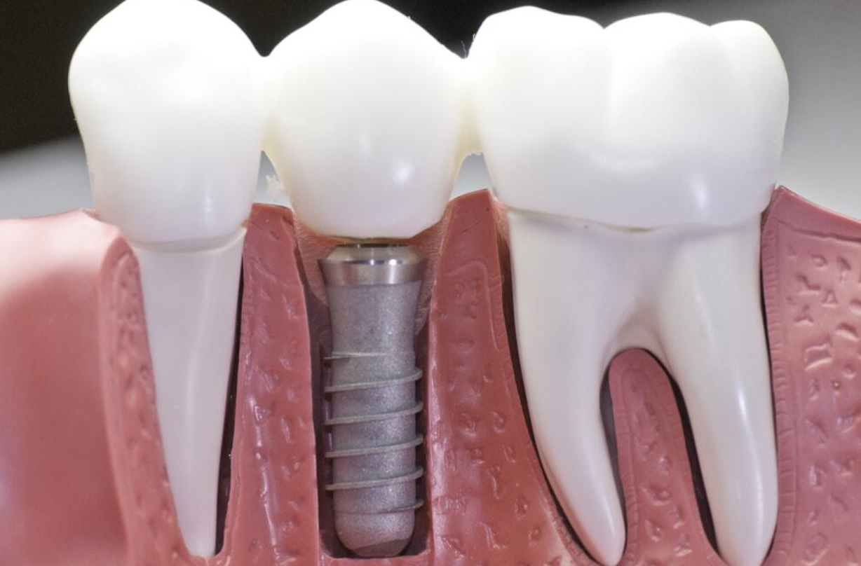 علت عفونت ایمپلنت دندان چیست و چگونه درمان می شود؟