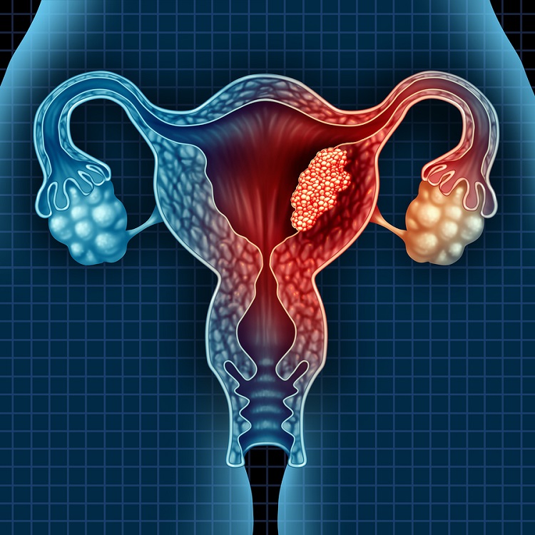 روش‌های تشخیص فیبروم: سونوگرافی، MRI، هیستروسکوپی