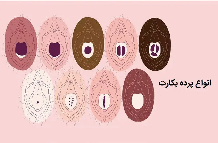 پرده بکارت هلالی