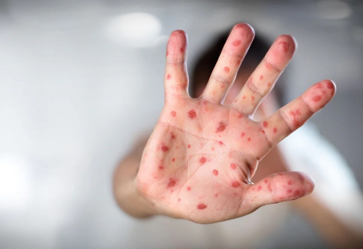 Unravelling_the_Duration_of_Chickenpox_Stages
