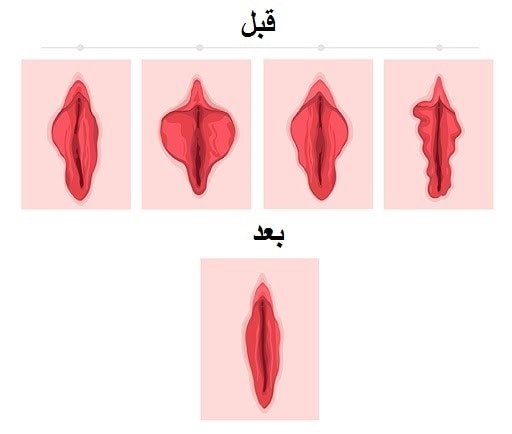 لابیا (1)