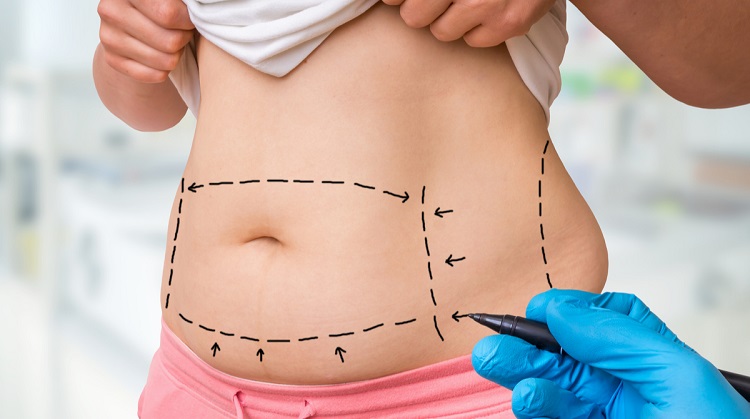 lipo-faq