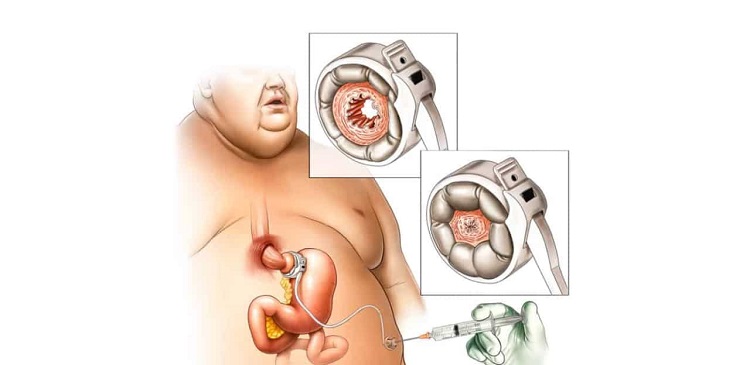حلقه معده یا گاستریک باندینگ چطور باعث لاغری می شود؟