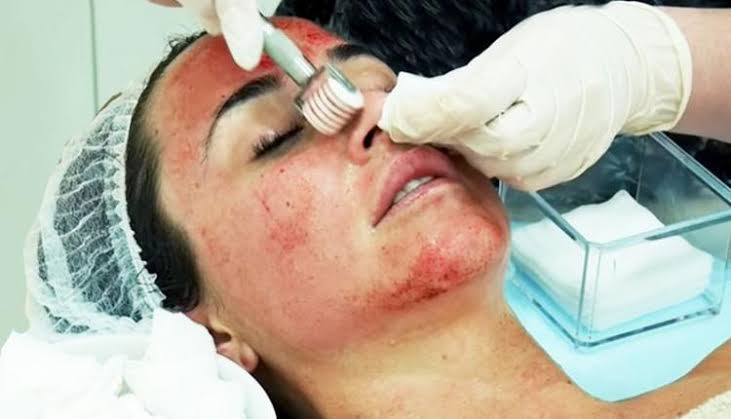 مقایسه میکرونیدلینگ با سایر روش‌های درمان 