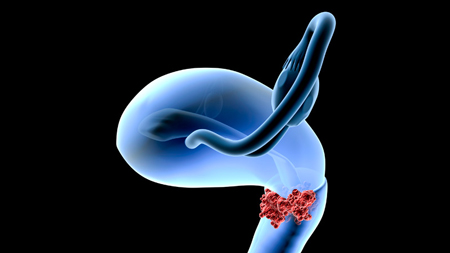 symptoms-cervical1-7