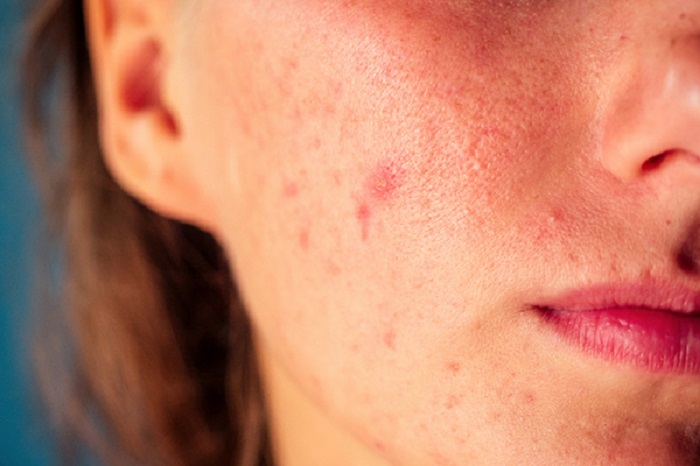 سریع ترین درمان جوش صورت بعد از اپیلاسیون
