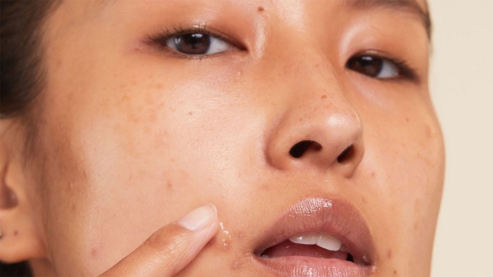 علت لک پوستی در خانم های جوان و میانسال: روش های درمانی