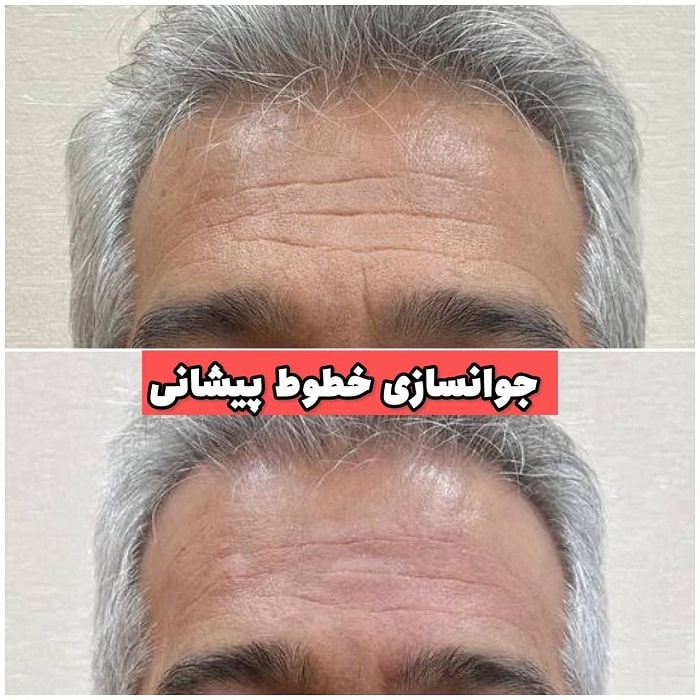 مزایای تزریق کلاژن