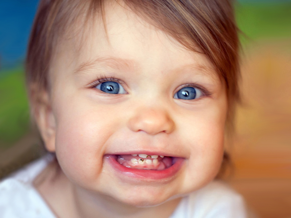 Baby-tooth-decay