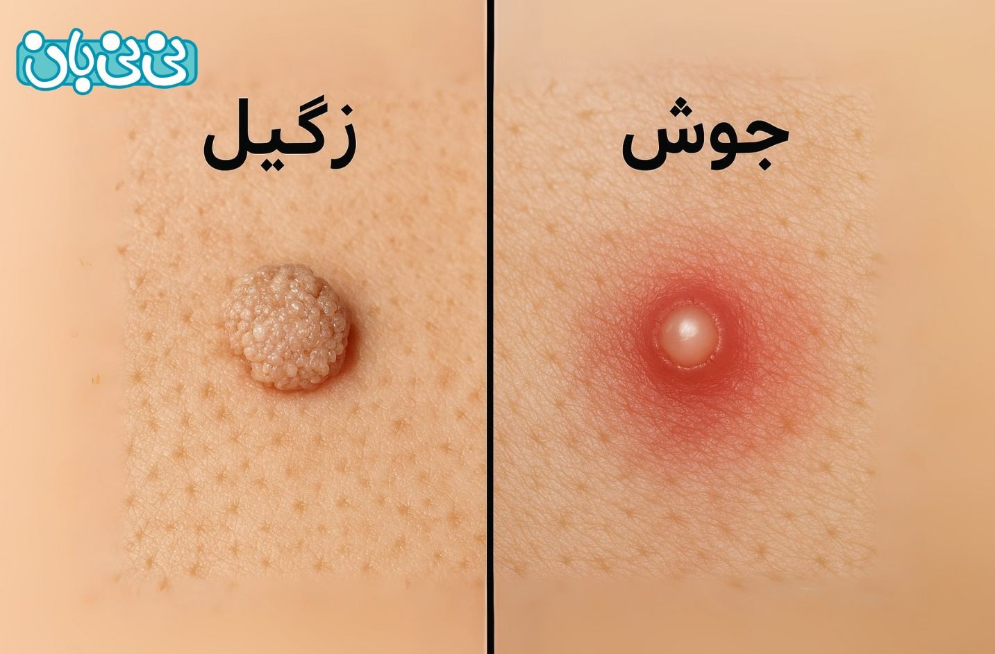 از کجا بفهمیم زگیل تناسلی داریم یا جوش؟