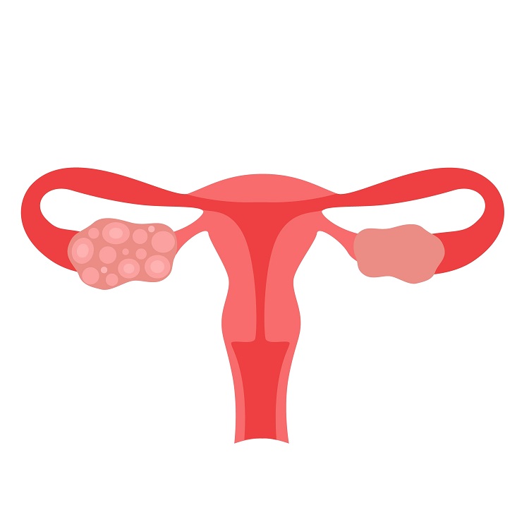 Fibroids111