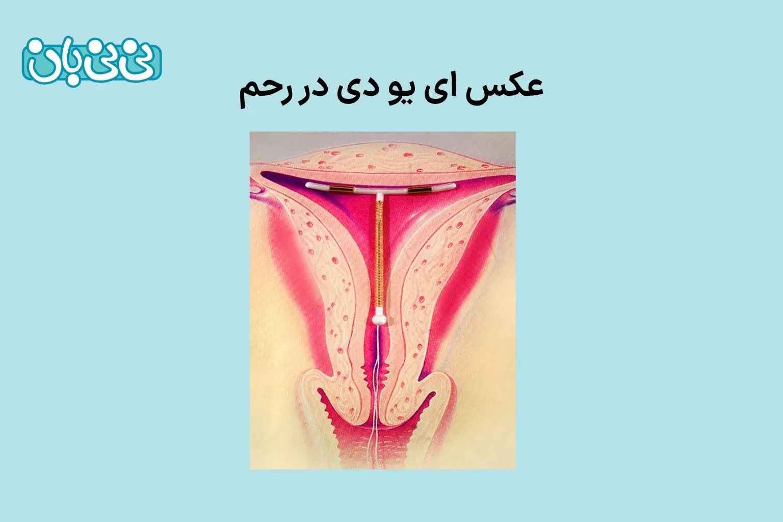 عکس ای یو دی در رحم