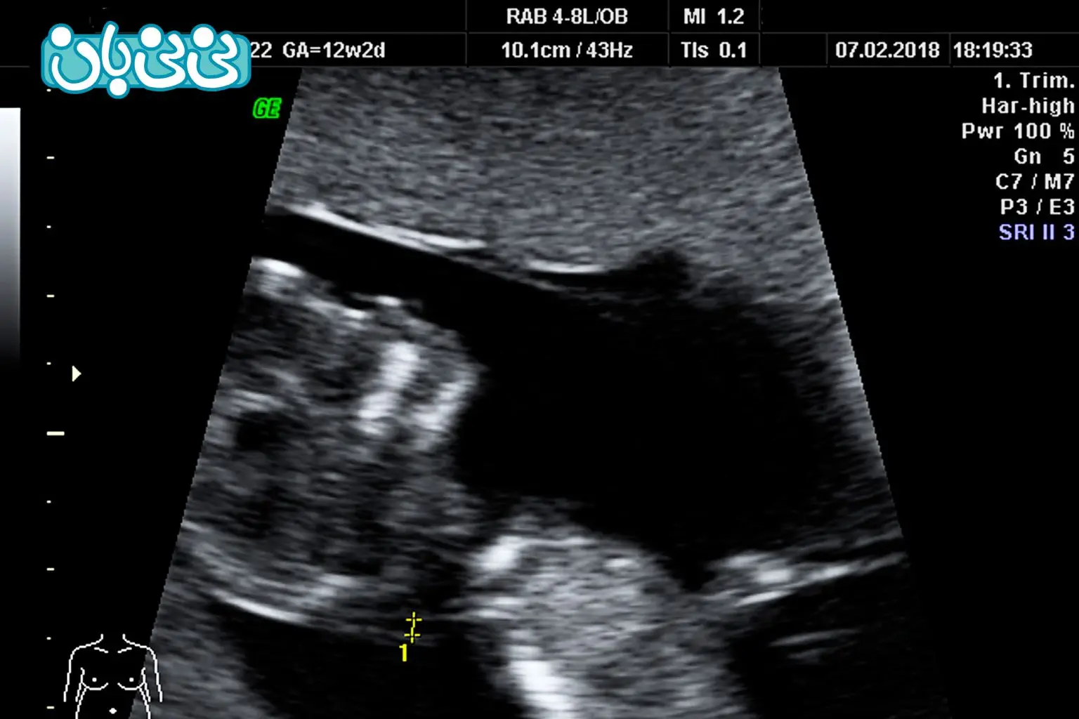 اگر میزان ان تی بالا باشد، چه باید کرد؟