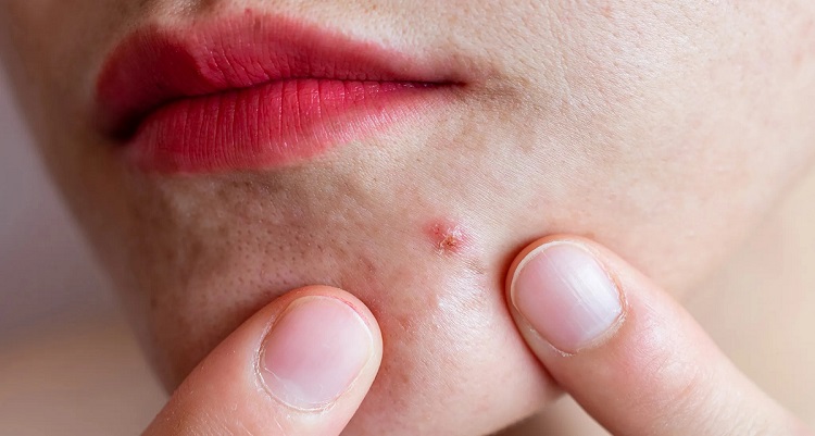 acne-from-menopause-universal-hero-image-of-a-woman-picking-at-a-pimple1