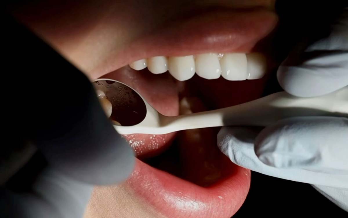 Dental laminate