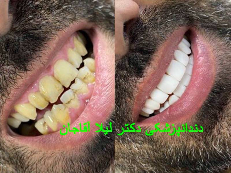 کامپوزیت دندان غرب تهران.webp