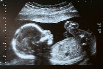 blog_Oct_24_2017_pregnancy-ultrasound-scary