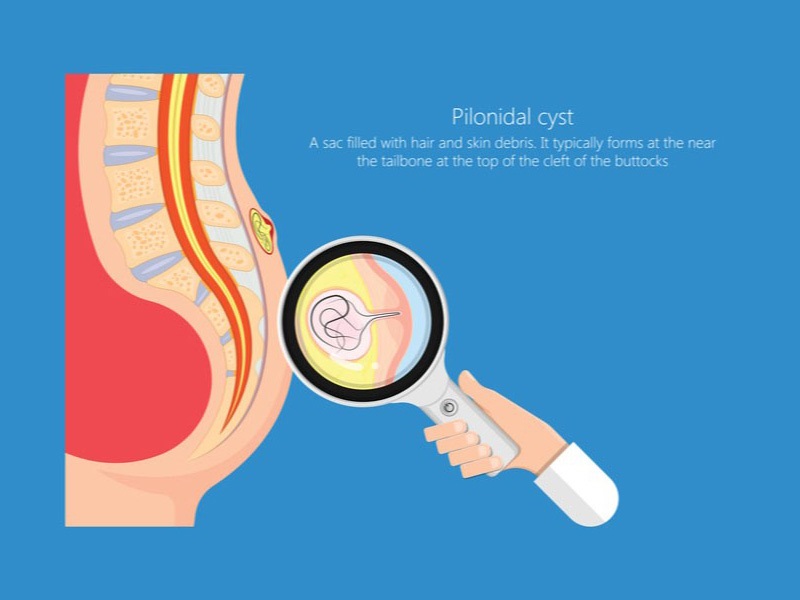 کیست پیلونیدال چیست؟ علائم و روش درمان
