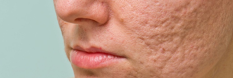 بهترین روش درمان اسکار صورت برای خانم ها
