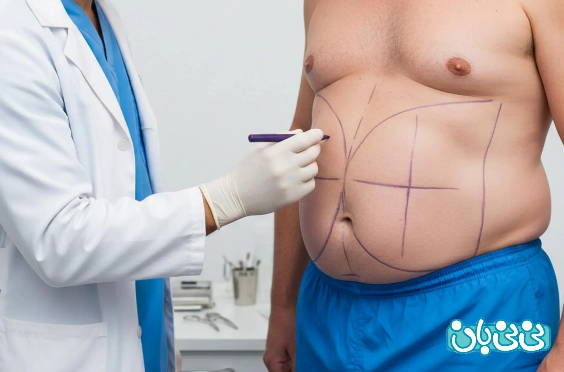 انواع عمل ابدومینیوپلاستی