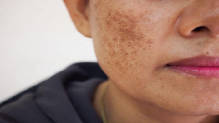 علت لک پوستی در خانم های جوان و میانسال: روش های درمانی