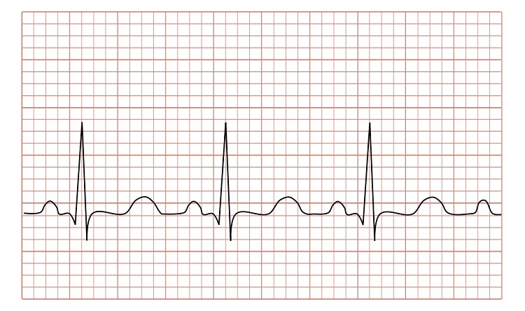 1200px-Tachycardia_ECG_paper