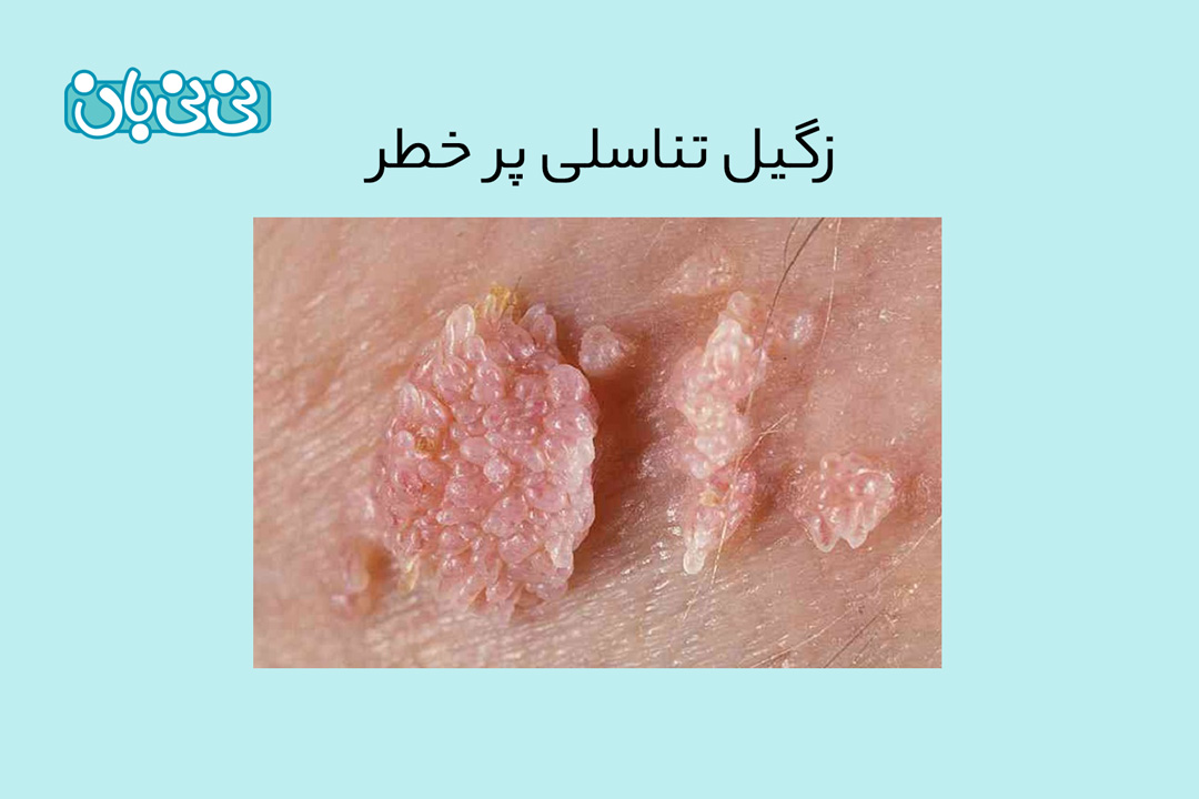 انواع زگیل تناسلی پر خطر کدام_اند؟