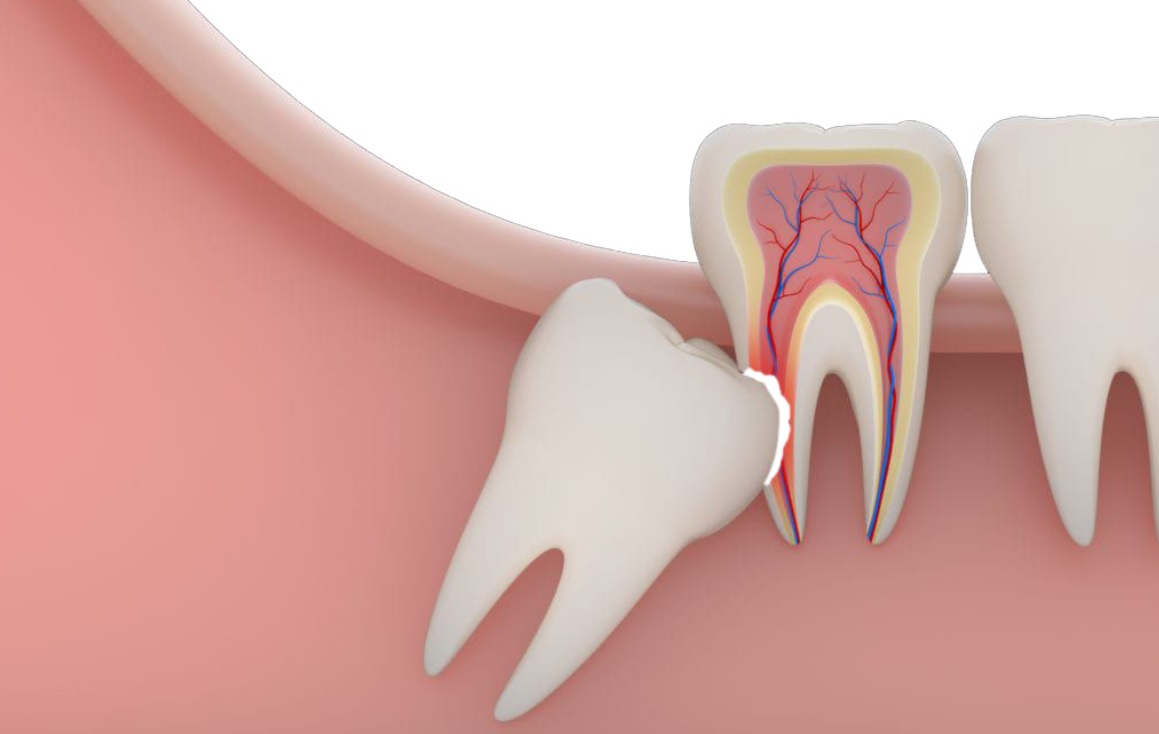 دندان عقل نیمه نهفته چه عوارضی دارد؟