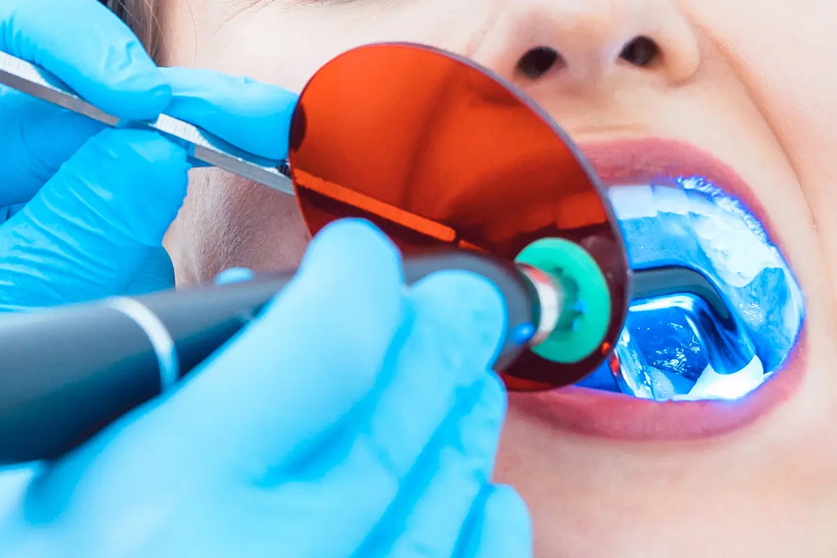 کاربرد دستگاه لایت کیور روی دندان