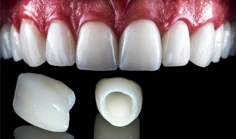 Imax-dental-veneers