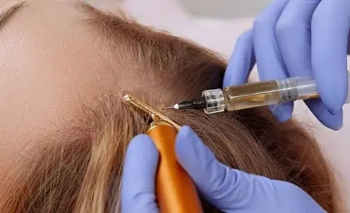 نحوه تزریق فیلر مو