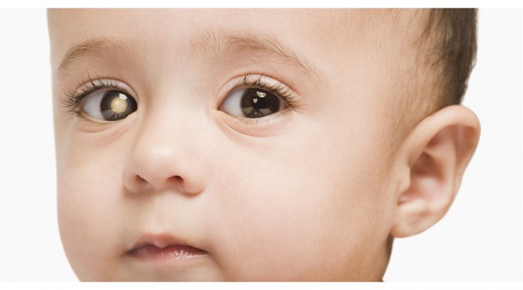 blog_retinoblastoma-a-rare-type-of-eye-cancer-affecting-children