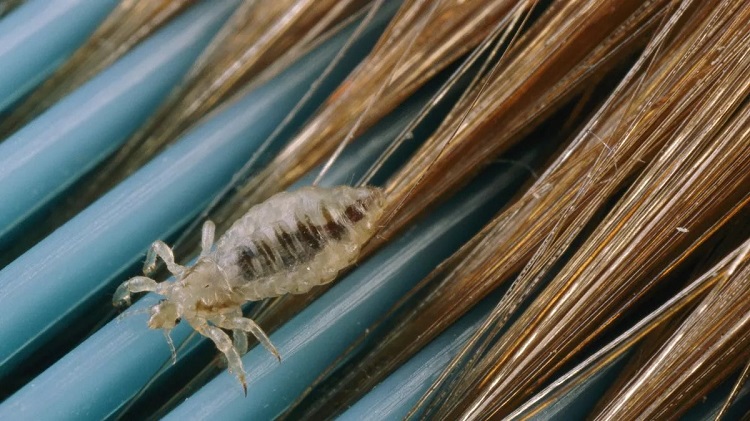 0_Head-louse-crawling-out-of-hair-onto-a-comb