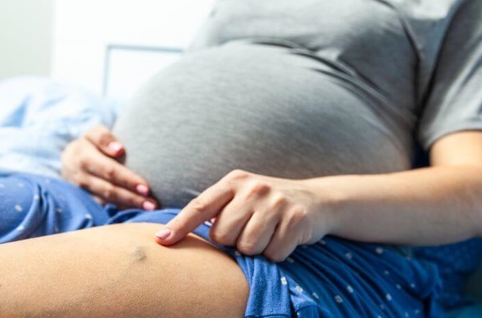 جلوگیری از واریس در بارداری، راهکار مناسب