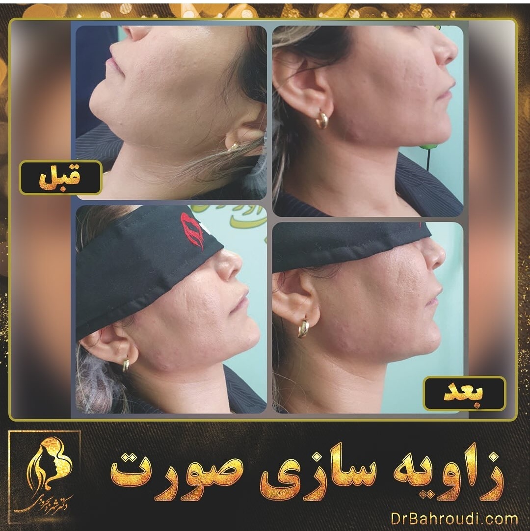 قیمت زاویه سازی صورت سال ۱۴۰۲ و ۱۴۰۳ چند در می‌یاد؟